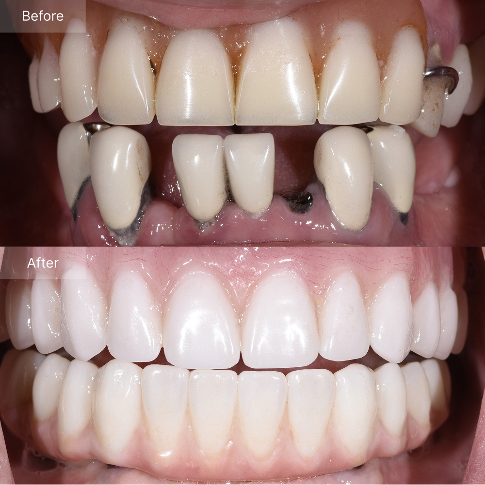 Before and after full arch implant reconstruction — failing teeth transformed into a bright, natural zirconia smile